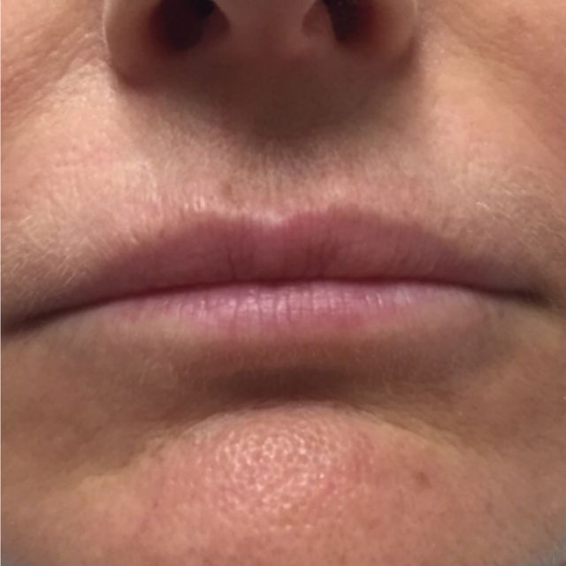 Permanent Makeup der Lippen vorher