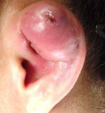 Pistole Ohr Piercer
